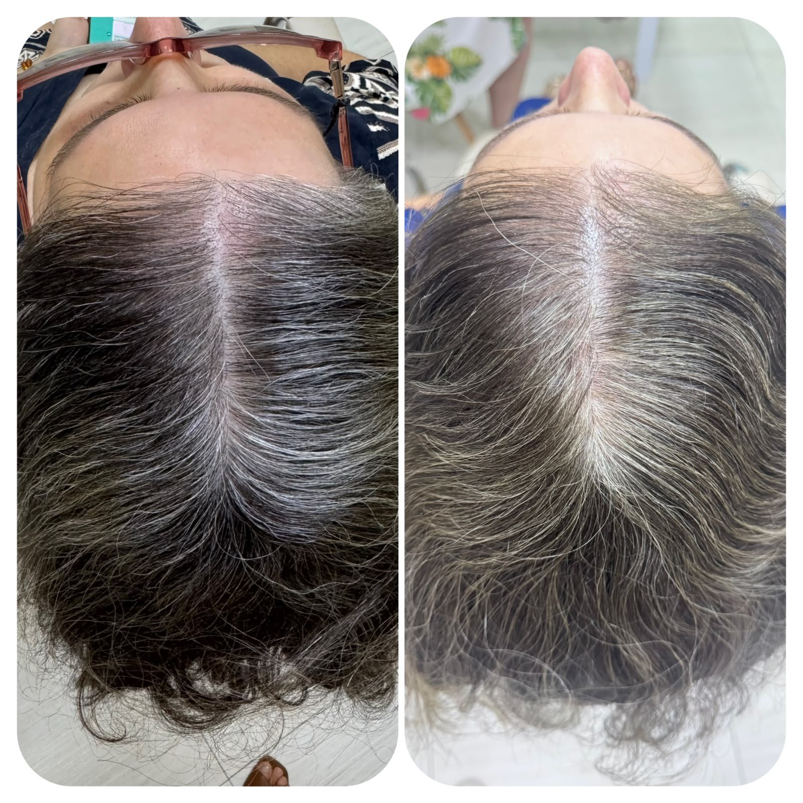 Antes e depois de paciente 2
