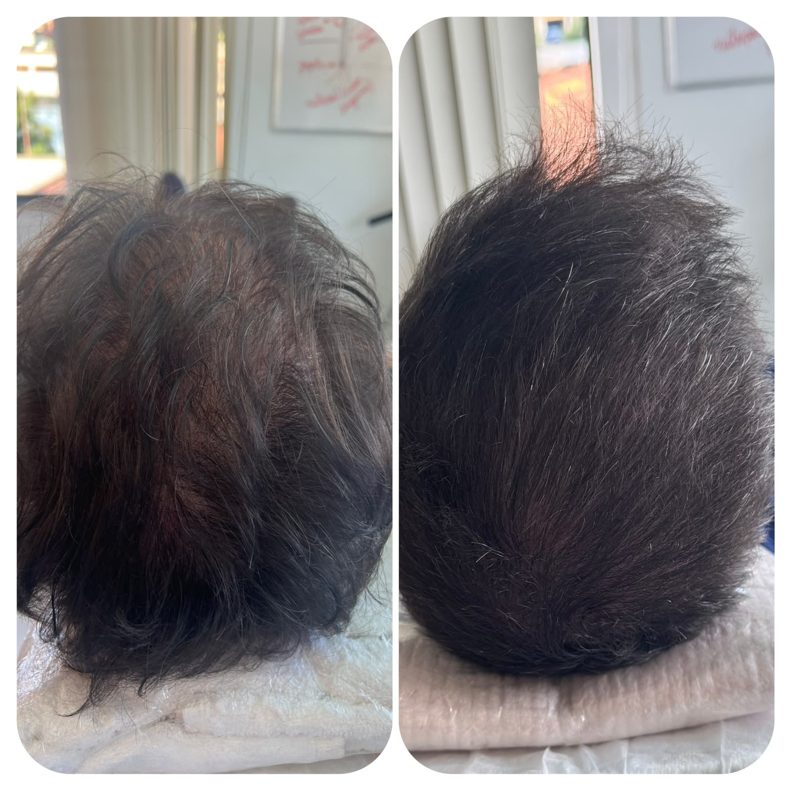 Antes e depois de paciente 3