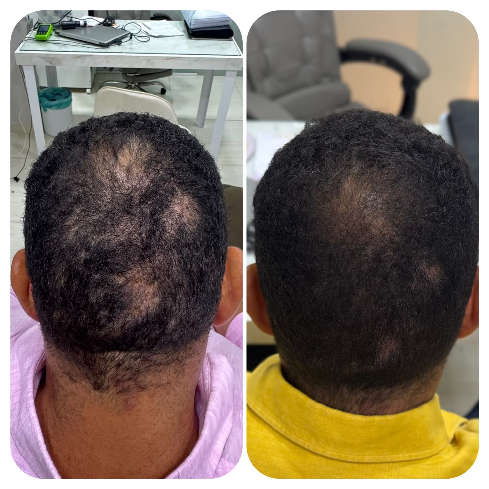 Antes e depois de paciente 4