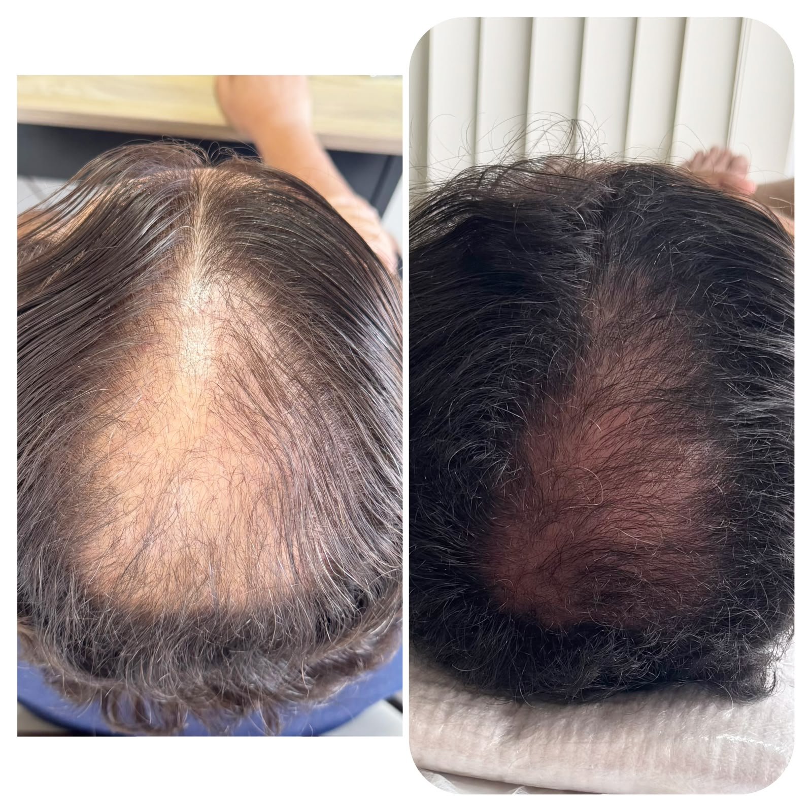 Antes e depois de paciente 1
